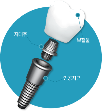커스텀 임플란트 개인 맞춤형 지대주