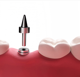 최종 보철 및 사후 관리