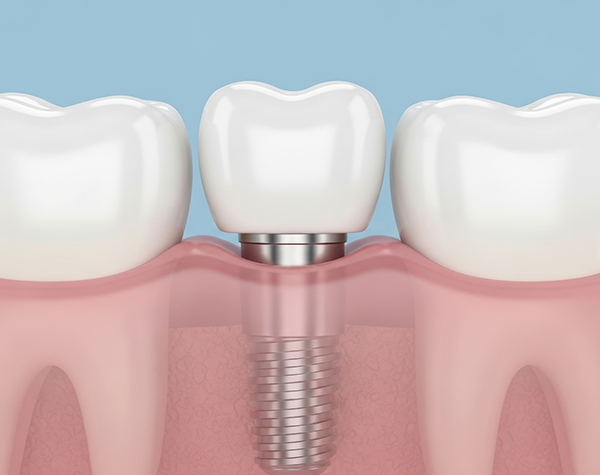 적은 임플란트로 전체 치아 기능 회복